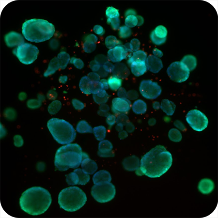 tumor-450px